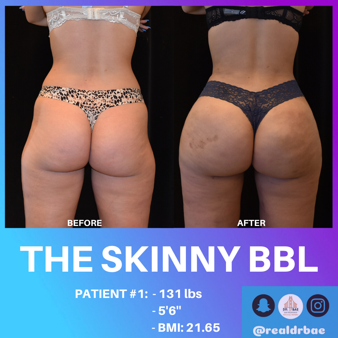 Brazilian Butt Lift with Implants vs Fat, Plastic Surgeon San Francisco