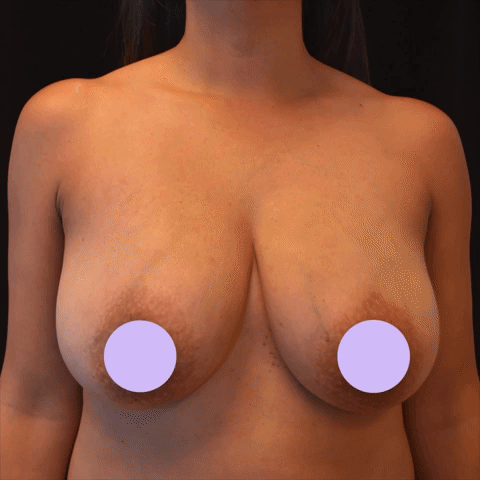 breast lift or implants