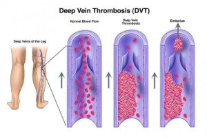 blood clots