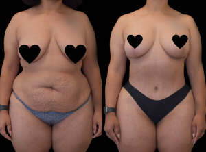 body contouring after weight loss